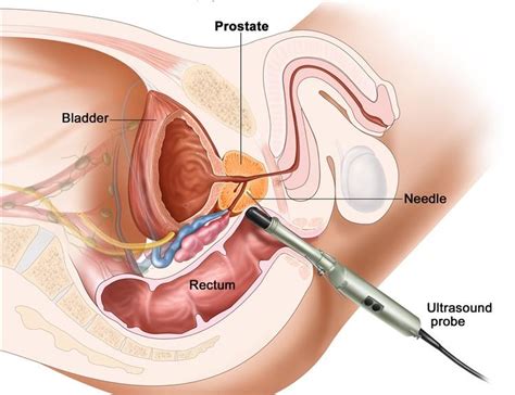 Men with diets high in animal fat may be at slightly higher risk of developing prostate cancer. What you Need to Know About Prostate biopsy | All To Health