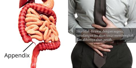 Apendisitis yang teruk merupakan radang apendiks. 3 Tanda Sakit Apendiks Mungkin Akan Berlaku Tanpa Anda ...