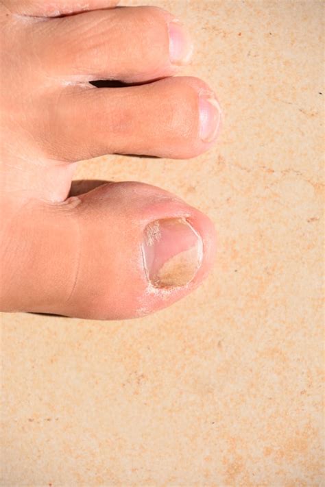 Foot fungus is a general term for the many different fungal infections you could catch on your feet or toenails. How to Tell if You Have a Toenail Fungus - Colorado Center ...
