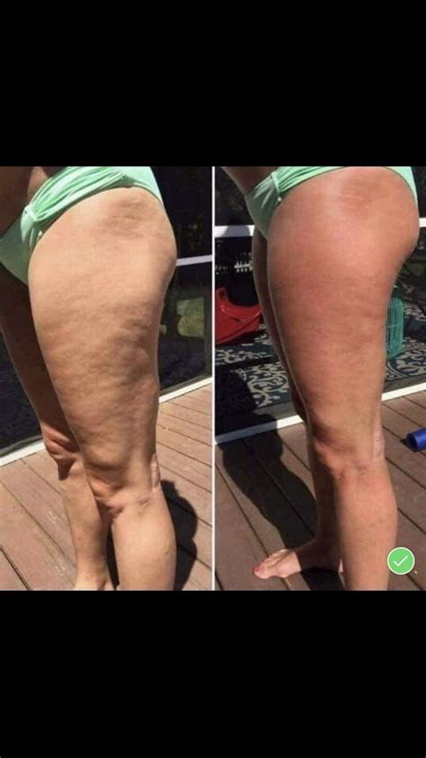 Efforts to win hearts and. Before and after Neora's Firm cream. | Leg firming cream ...
