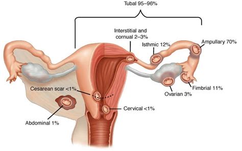 Ectopic pregnancy (kehamilan luar rahim), lagi menakutkan… sakit perut teruk nak pengsan dan nasib baik masa itu cepat pergi hospital. Kenali Penyebab Hamil Di Luar Kandungan