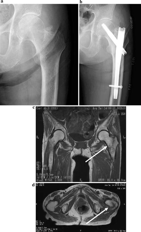 Avulsion fractures of the lesser trochanter are rare. Insufficiency femoral intertrochanteric fractures ...