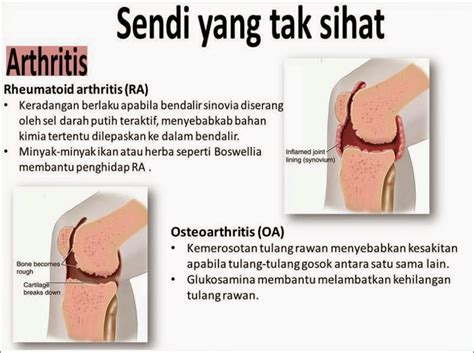 Penyebab yang paling sering ditemui adalah akibat infeksi virus maupun bakteri. CARA MERAWAT SAKIT LUTUT DENGAN CEPAT DAN SELAMAT - CUTE ...