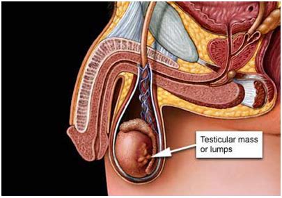 Painless enlargement of one testicle. India Surgery Testicular Cancer,Testicular Cancer ...