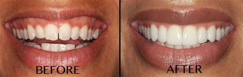 The lip is cut from the inside and stitched closer to the. Smile Gallery - South River Periodontics