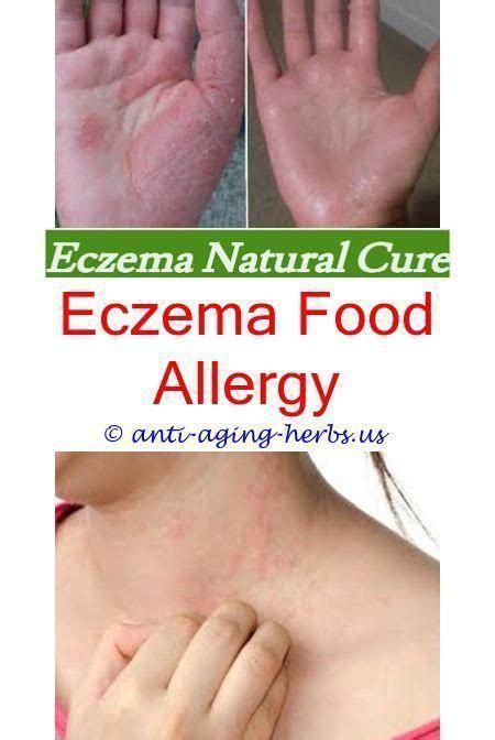 Qual è la migliore crema per l'eczema. Rimedio naturale ...
