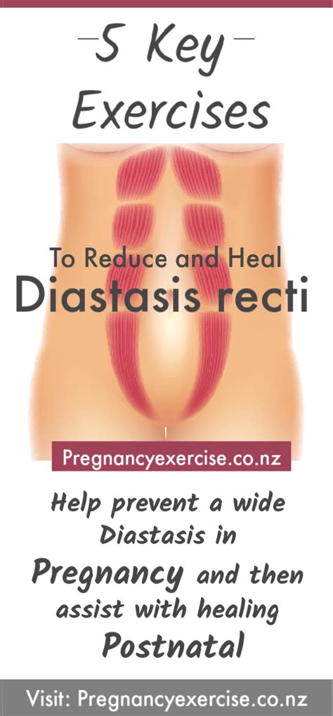 Diastasis recti is a separation of the abdominal muscles after birth. Diastasis Recti Exercises | Diastasis recti exercises ...
