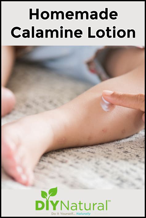 Homemade Calamine Lotion Recipe: You Can Make it Naturally ...