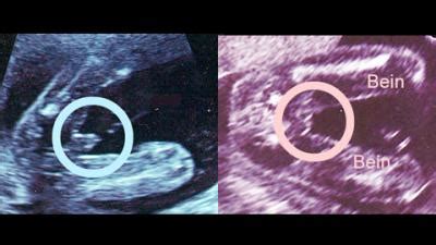 Eine schwangerschaft in den wechseljahren ist durchaus möglich. Mädchen im Ultraschall - babywelten.ch