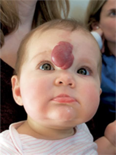 The strawberry birthmark falls under the first category. Birthmarks. Causes, symptoms, treatment Birthmarks