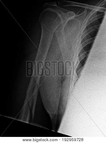 594 x 800 jpeg 85kb. Broken Humerus X-ray Image & Photo (Free Trial) | Bigstock