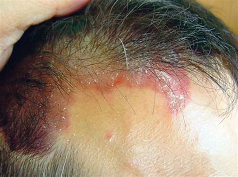 Kulit kepala terasa gatal, berwarna kemerahan, dan bersisik? Tips mudah mengobati gatal pada kulit kepala ...
