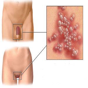 Apa yang kamu ketahui tentang kata, kalirnat, frasa dan bahasa baku ? AKU HIV POSITIF: GONORRHEA- INFO SIHAT