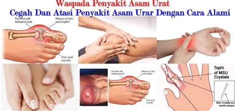 Modern possibilities of gout therapy. Asam Urat Akut sembuh dengan teh pepaya kelapa | Resep Ala ...