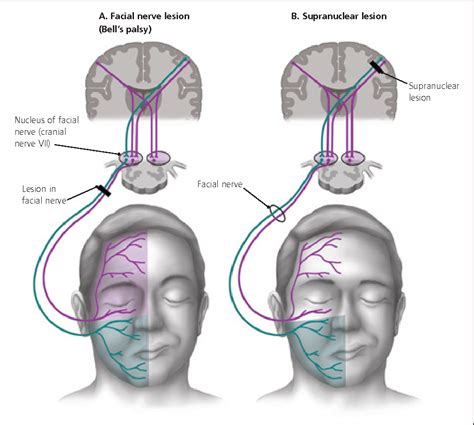 Bell's palsy results in weakness of the facial muscles. Figure 2 from Bell's palsy: diagnosis and management ...