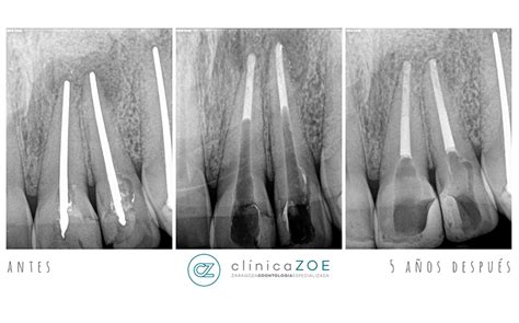 Sanchez • las lesiones traumáticas en dientes permanentes son comunes y. Endodoncia con Apicoformación | Zaragoza Odontología ...