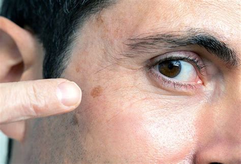 The main form of treatment for skin cancer is surgery to remove the cancerous spot or spots. What Does Skin Cancer Look Like on Your Face?
