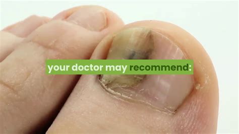 An overbite in dog's is not typically fixed. how to fix ingrown toenails at home - YouTube