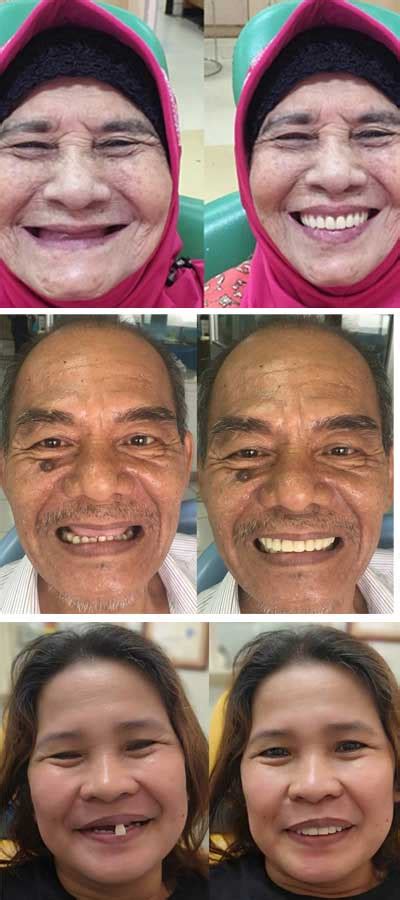 Jenis gigi palsu depan atas. *Terbaik* Dokter Pasang Gigi Palsu Medan | Puri Dental Clinic