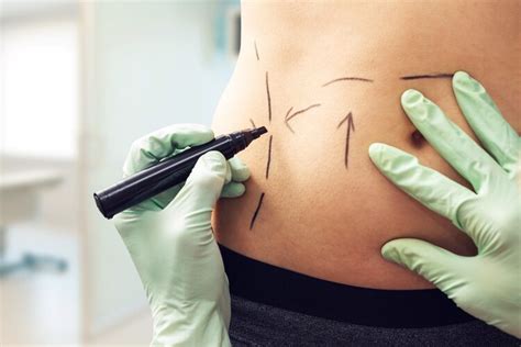 How bad will the scarring be? How much does it cost to get Liposuction in USA
