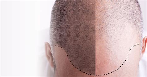 Jfm products last up to 8 weeks or until the grey grows back. Weight Loss, Slimming, Beauty Salon, Hair Transplant: PRP ...