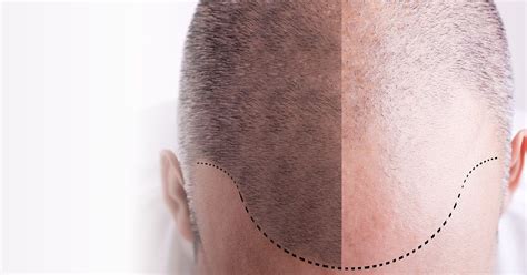 Get your hair back with the artas® robotic hair restoration procedure! Weight Loss, Slimming, Beauty Salon, Hair Transplant: PRP ...