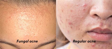 Fungal acne is actually an infection of the hair follicle scientifically called pityrosporum folliculitis or malassezia folliculitis. Kenali Fungal Acne dan Cara Ampuh Mengatasinya ...