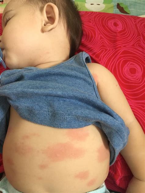 Apa beza bayi cirit birit dan najis bayi yang normal? 'Anak muntah 9 kali sehari, muka dan badan merah-merah ...