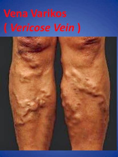 Sin embargo, las venas afectadas con mayor frecuencia son. Stokin Vken, Stokin Ajaib!: Kenali masalah Vena Varikos ...
