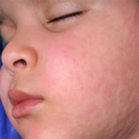 Peanuts allergy symptoms may include skin rash, hives, swelling of the tongue or throat, breathing problems including asthma, vomiting or diarrhea, and abdominal pain. Toddler Allergy Definition and Types