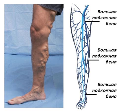 Суральных вен голени