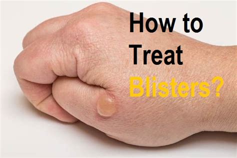 Blisters are the body's response to an extreme event. how to treat blisters