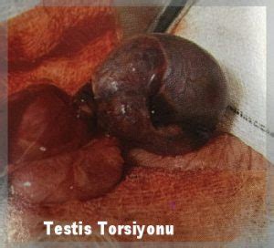 Böylece yemin edilirken, testisler erkeğin gücüne ve yiğitliğine. Testis torsiyonu (testis dönmesi) - Antalya Narkozsuz ...