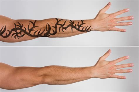 The removal process requires time and patience to ensure both safety and efficacy. Laser Tattoo Removal: How Long Does It Take to See Results?