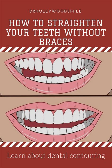 Dechter and moy can work with you to develop a solution that best suits your needs. How to Straighten Your Teeth Without Braces | Fix teeth ...