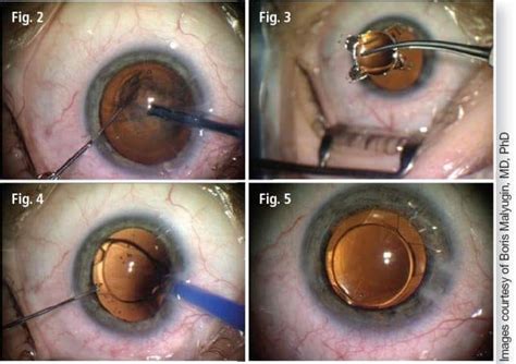 Cataracts often affect people as they age, causing blurry, dim vision that gets worse over time. ‫طب وجراحة العيون في الأردن - Home | Facebook‬