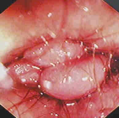 The unqualified term hemorrhoid is often used to refer to the disease. How to get rid of Hemorrhoids without Surgery ...