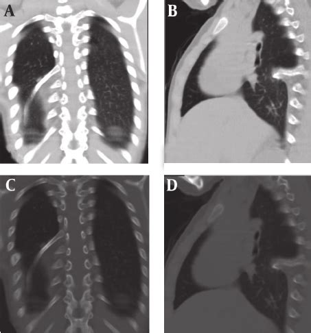 Polish your personal project or design with these coronal plane transparent png images, make it even more personalized and more attractive. A and B, Lung window; A, Coronal plane; B, Sagittal plane ...