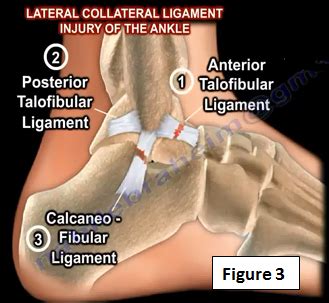 Ankle sprains or ligament injuries can commonly be divided into two groups; Chronic Lateral Ankle Instability | HuffPost