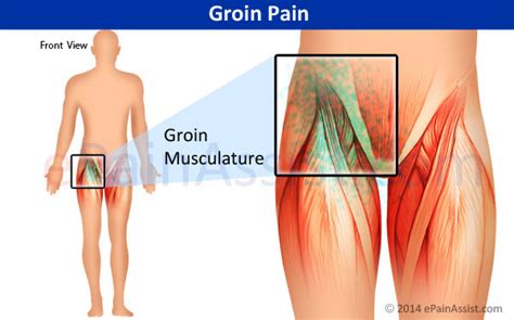 Repeated strains in muscles about the hip and pelvis may be associated with athletic pubalgia (also called sports hernia). Groin Pain|Types|Symptoms|Causes|Treatment