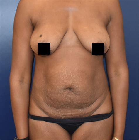 The latest tweets from jen richards (@smartassjen). Tummy Tuck Before and After Photos by Richard Reish, MD ...