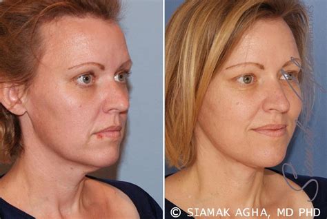 Facelift Before & After Photos - Patient #2 in Newport Beach
