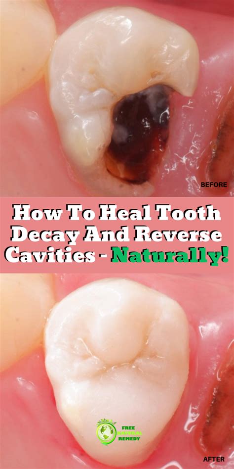 Fluoride is necessary for remineralizing teeth and reversing tooth decay. How To Heal Tooth Decay And Reverse Cavities - Naturally ...