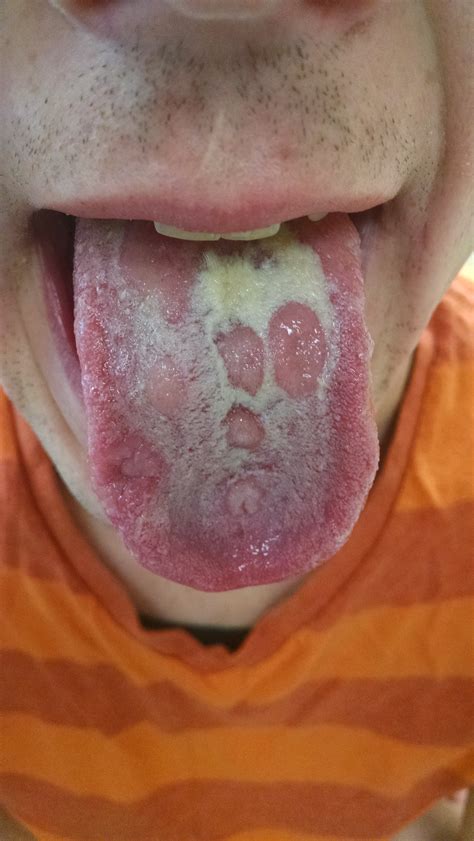 Transmission, signs, symptoms in men and women, disease stages, diagnosis and treatment, antibiotics. Syphilis - Image of Lesions of secondary syphilis