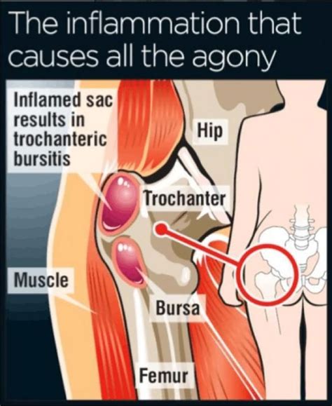 The foot is then further dissected down to locate the fdl, which can be identified as a tendon that flexes the 2nd, 3rd, 4th, and 5th toes. Pin on Hip Flexor