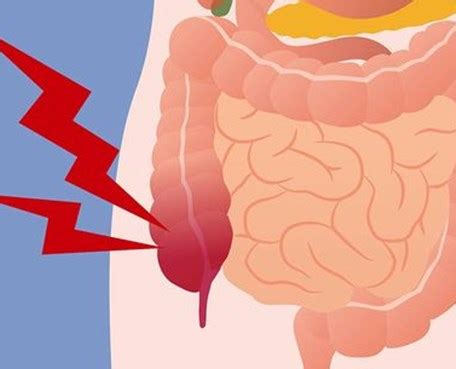 De ontsteking kan soms zeer heftig verlopen en buikvliesontsteking veroorzaken. Appendicitis (Blindedarmontsteking)