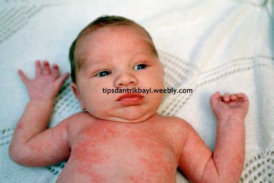 Bintik merah pada bayi merupakan permasalahan umum yang pasti dihadapi oleh semua orang tua. Bintik Merah pada Kulit Bayi disertai Demam - Tips dan ...