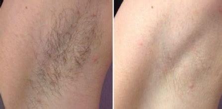 This kind of radiation does not cause skin cells to mutate. Laser Hair Removal Arlington | Medical Spa TX