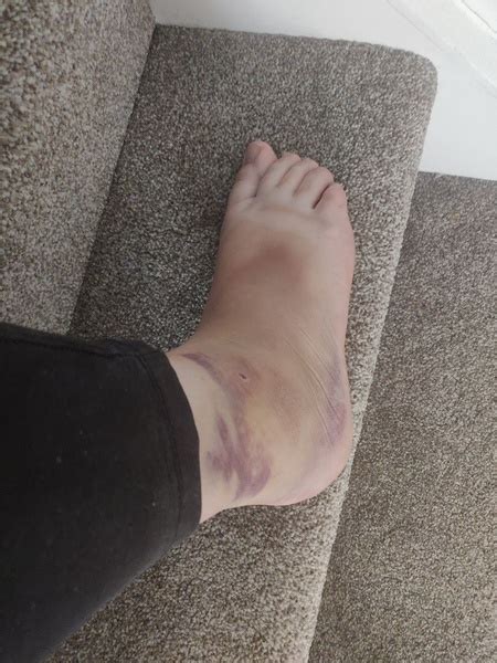 Was merged with this question. To call in sick with a sprained ankle? | Mumsnet