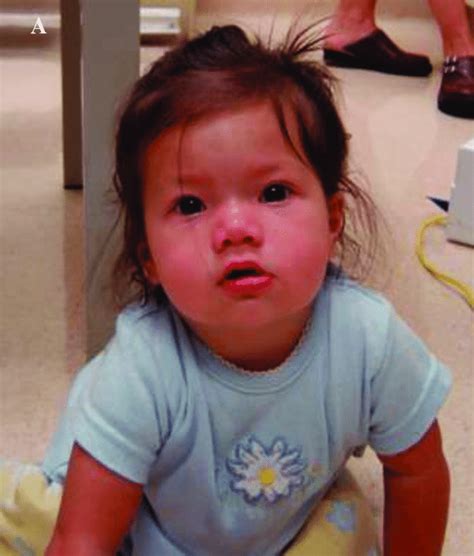 About 60% of individuals with down syndrome (also known as trisomy 21) have. Flat Nasal Bridge And Epicanthal Folds / Fetal Alcohol ...